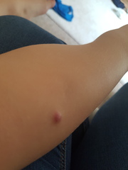 Worried about infection - too much googling
