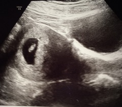 Not sure what to expect at early scan