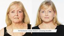 Could a £6000 facelift really achieve these results?
