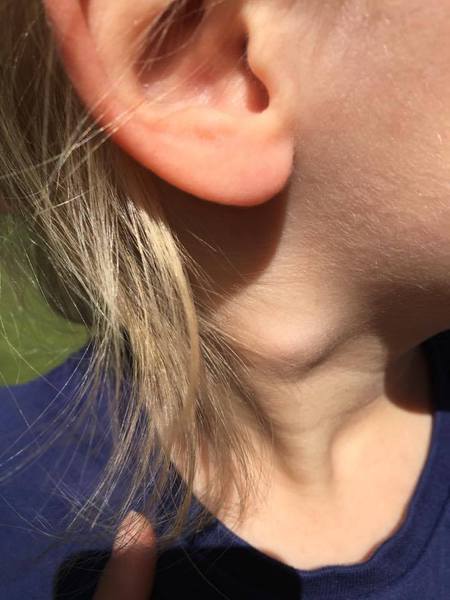 Lump on DD neck