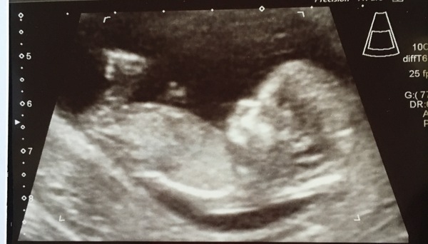 Gender guess for 12 week scan
