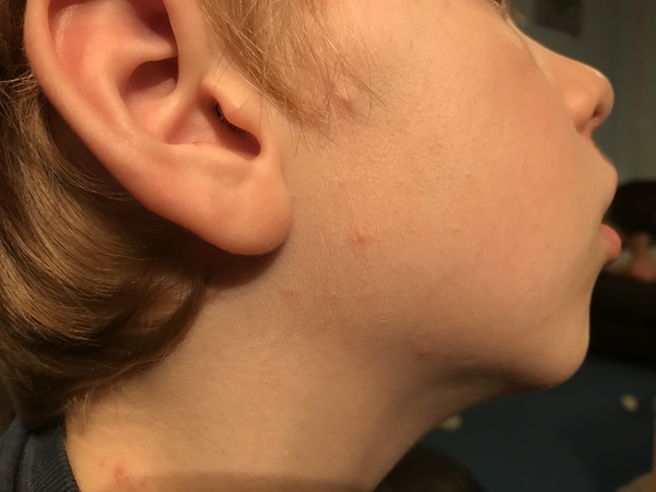 What are these bites/rashes/something???