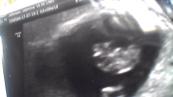 Pregnancies due March 2018