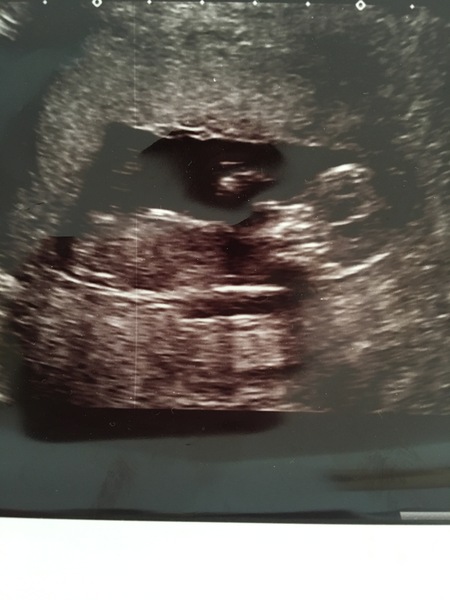 Nub theory/Boy or Girl guesses please?