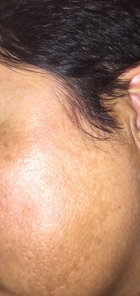 Hyper pigmentation