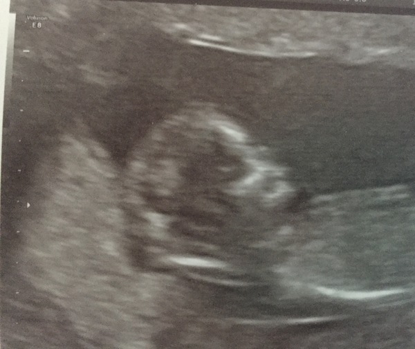 12 week scan - is there a nasal bone?