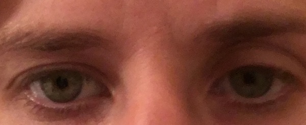 What can I do about my dodgy eyelids? Pic!
