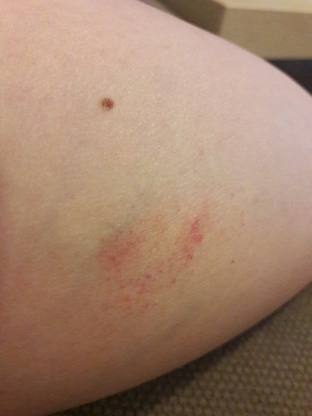 Funny looking patch on leg (pic)