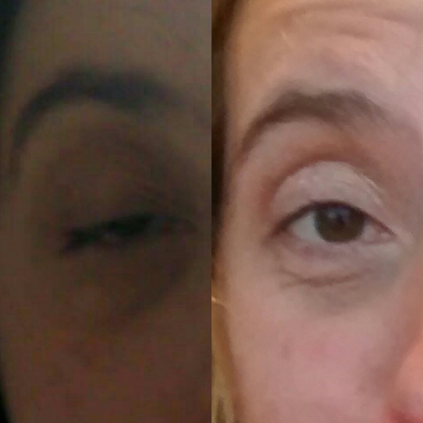 What can I do about my dodgy eyelids? Pic!