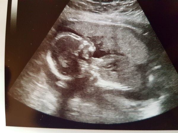 20 week scan... It's a girl!
