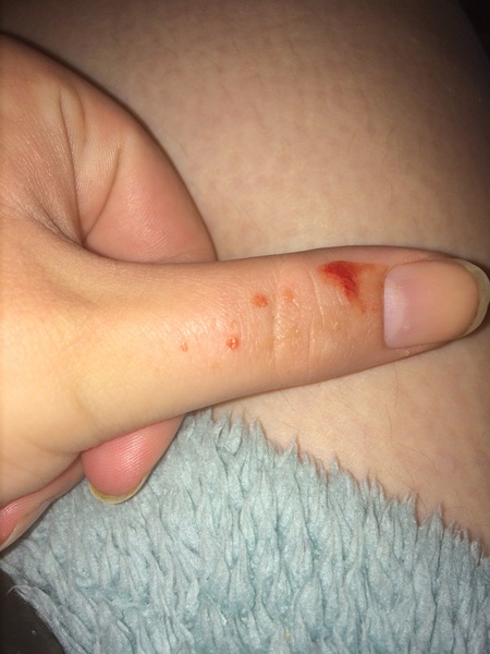 Septic spot thing popped!!!