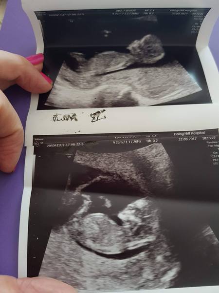Pregnancies due March 2018