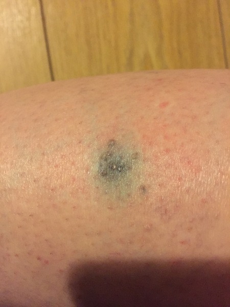 So this thing on my leg....