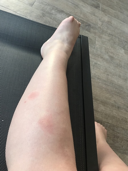 Is this bite ok? Picture attached.