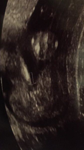 Boy or girl? 20 week ultrasound