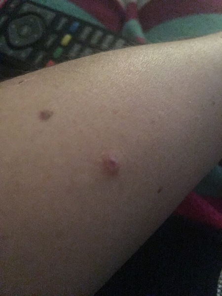 Would you like to see what I just got out of my arm?