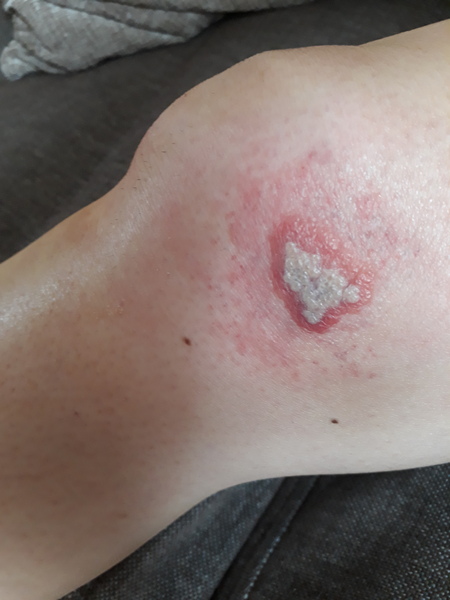 Is this cellulitis?