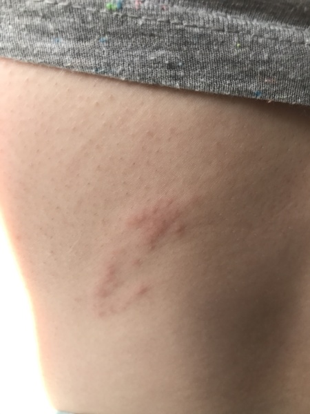 Shingles?