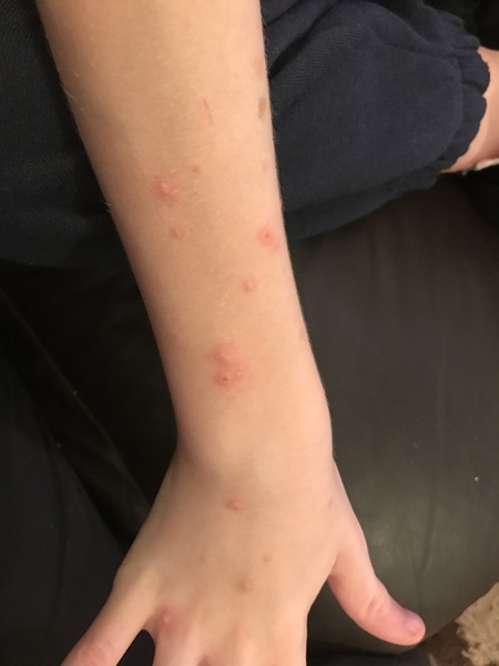 What are these bites/rashes/something???