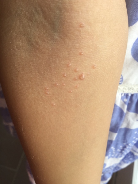 Is this molluscum or something's else (photo)