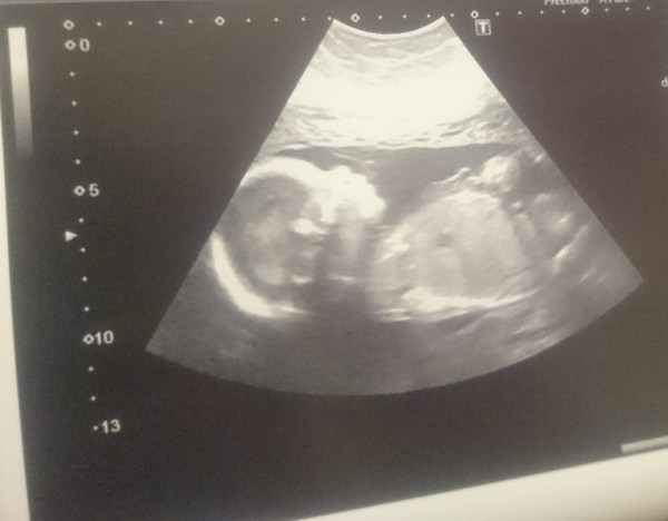 20 week scan today!! Baby is perfect!!