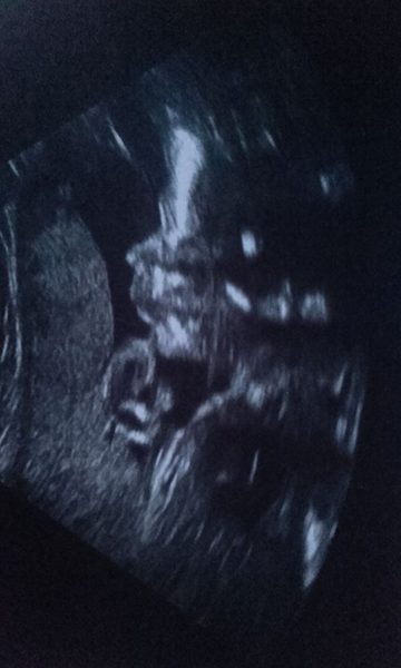 Is my ultrasound normal?