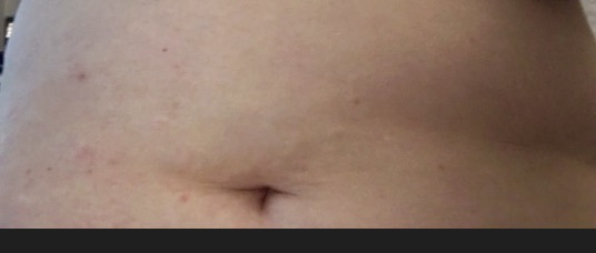 Protruding tummy weird tummy shape