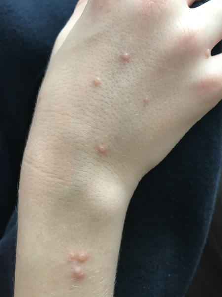 What are these bites/rashes/something???