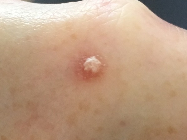 Is this a wart?