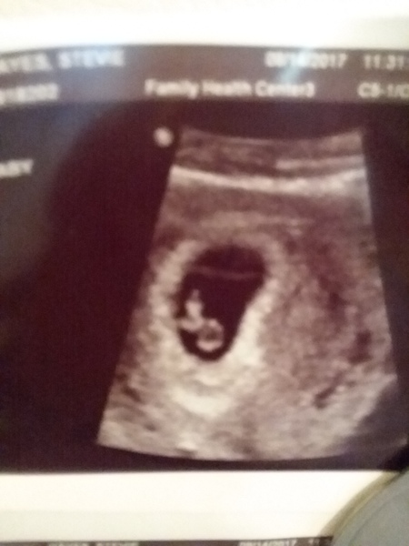 Grab your scans ladies for the...drumroll...Ramzi Placenta Theory!