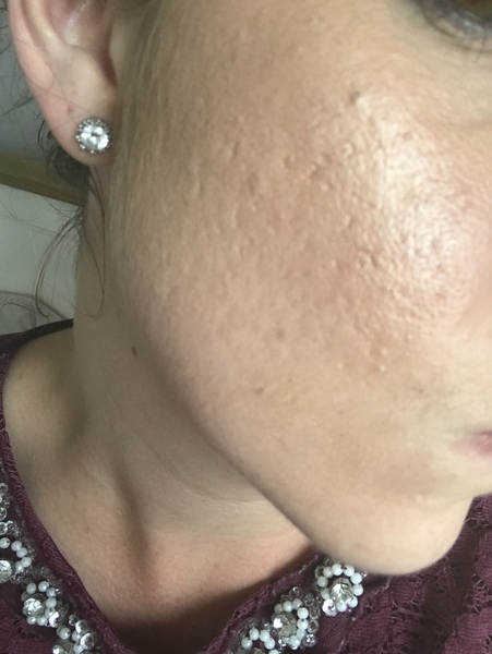 Acne scar help!!
