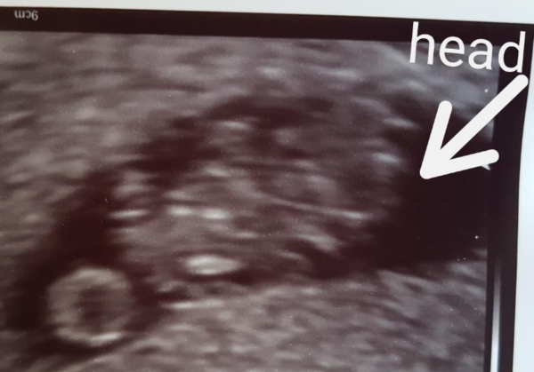 Pregnancies due March 2018
