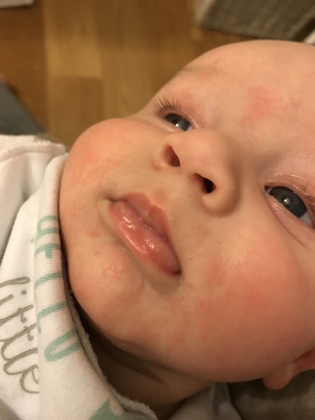 Baby rash?