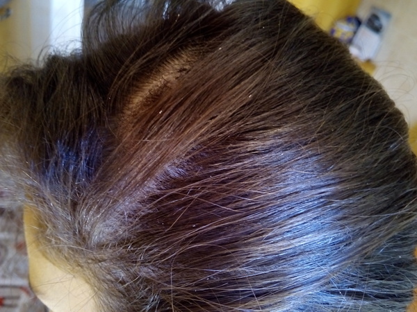 Dandruff or nits/lice?