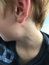 What are these bites/rashes/something???
