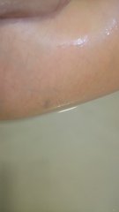 Does this look the start of varicose veins