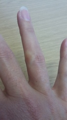What is wrong with my knuckle (pic)?