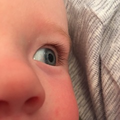 Red/Brown patch in eye - 6 month old