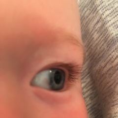 Red/Brown patch in eye - 6 month old