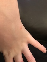 What are these bites/rashes/something???