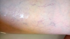 Does this look the start of varicose veins