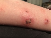 What are these bites/rashes/something???