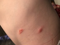 What are these bites/rashes/something???