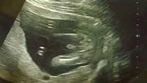 gender scan at 17 weeks...girl or boy...i think im in denial!?!?!?
