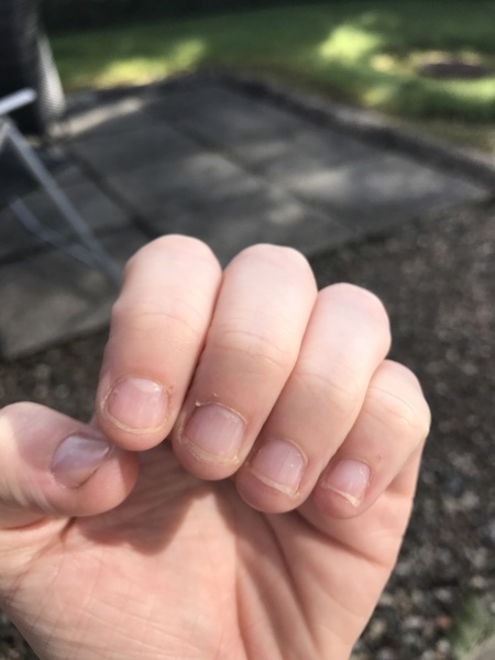 Bitten nails!