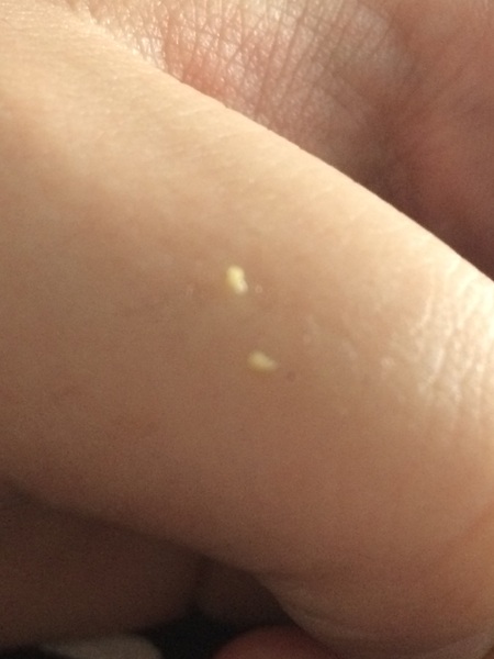 I think I have a tonsil stone??? *pics*