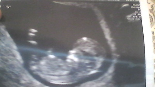 11 weeks 3 days pregnant  due 14/03/2018 and need advice please