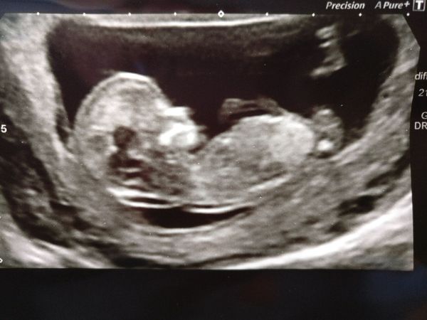 Pregnancies due March 2018
