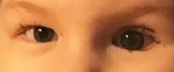 Should I take daughter to A&E? What's wrong with her eye? (pic)