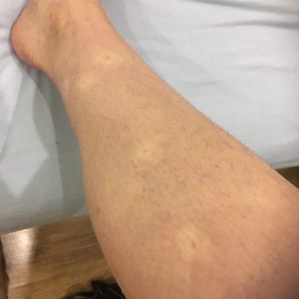Are these mosquito bites?